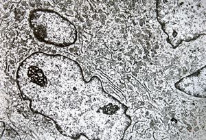 F,25y. | giant multinuclear osteoclast - aneurysmatic cyst - tibia